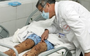 Hà Nội: Nữ sinh 18 tuổi hôn mê vì nhiễm não mô cầu