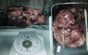 Cả xã hội đang 'oằn mình' vì gánh nặng ung thư