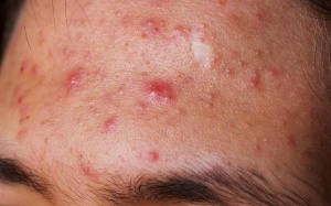 Mụn bọc mọc nhiều trên trán có dùng được Azacné?