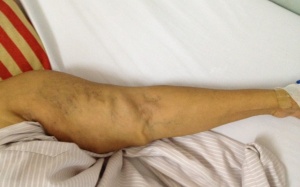 Mảnh đạn nằm trong cơ thể 43 năm xé rách mạch máu