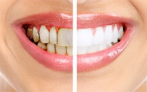 Australia phát triển vaccine đầu tiên trên thế giới phòng bệnh nha chu