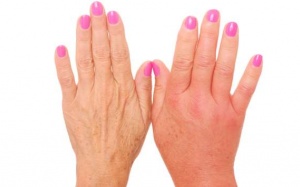 Sưng ngón tay vào mùa Đông - Đối phó như thế nào?