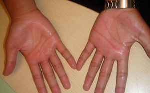 Viêm tuyến mồ hôi có đáng ngại?