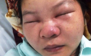 Cứu nữ bệnh nhân suýt chết vì… nặn mụn