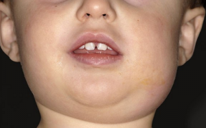 16 em bé mắc bệnh quai bị ở trường tiểu học Sài Gòn