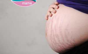 Lựa chọn sản phẩm trị rạn da sau sinh nào?