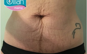 Kem bôi rạn da sau sinh được tin dùng nhiều