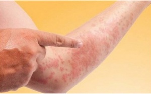 42 công nhân nhập viện nghi do dị ứng thức ăn