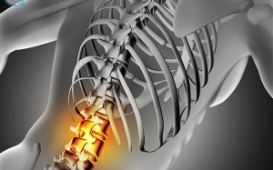 Điều trị bệnh gai cột sống như thế nào mới hiệu quả