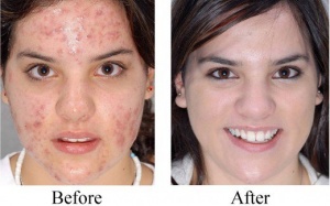 Làm sao để trị sẹo do mụn trứng cá một cách hiệu quả?