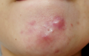 Lưu ý khi dùng kháng sinh để điều trị mụn nang