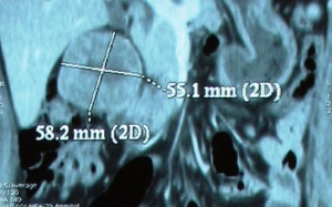 Dấu hiệu nhận biết bạn bị ung thư thận