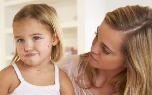 5 cách đơn giản giúp bạn 'thổi bay' vết sẹo thủy đậu