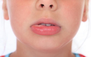 Hội chứng dị ứng đường miệng là gì?