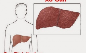 Bệnh xơ gan có chữa được không?