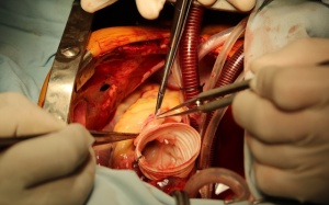 Cứu sống bé trai 12 tuổi bị vỡ phình bóc tách động mạch chủ