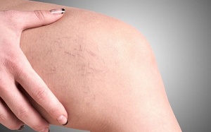 Tại sao triệu chứng suy giãn tĩnh mạch thêm trầm trọng vào mùa Đông?