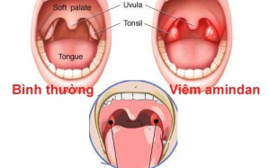 3 dấu hiệu nhận biết viêm amidan bạn nên biết 