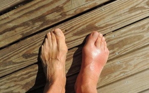 Ăn bánh mì nướng cùng đậu giúp giảm cơn đau do bệnh gout