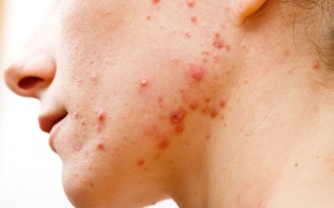 Làm sao để ngăn ngừa tái phát mụn trứng cá?