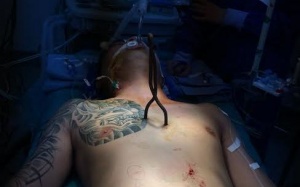 Cứu sống nam thanh niên bị 6 vết đâm ở tim rất phức tạp