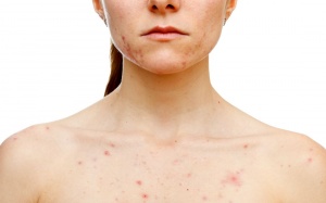 Các biện pháp trị mụn trứng cá trên cơ thể