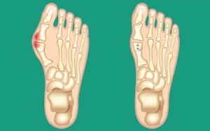 8 cách giảm đau hiệu quả cho người bị biến dạng ngón chân cái