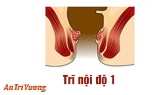 Bệnh trĩ nội độ 1 là gì và cách chữa trị