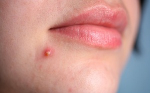 Các loại hạt tốt cho những người bị mụn trứng cá