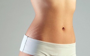 Rạn da từ tuổi dậy thì là vì sao?