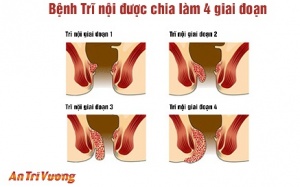 Những dấu hiệu biểu hiện triệu chứng của bệnh trĩ nội
