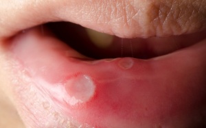 Làm gì để hết nhiệt miệng do ăn nhiều đồ nóng ngày Tết?