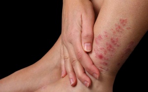 Làm sao để giảm đỏ da do vẩy nến?