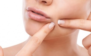 Chớ dại mà nặn 5 loại mụn này!