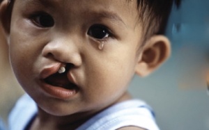 Phẫu thuật miễn phí sứt môi, hàm ếch, tai mũi họng