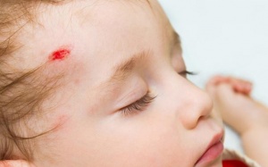 Chớ coi thường khi trẻ bị té ngã