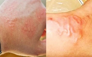 Thấy ai trong gia đình có dấu hiệu này, cần phải xổ giun ngay lập tức