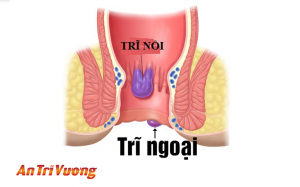 Tìm hiểu về bệnh trĩ và cách phòng tránh bệnh trĩ hiệu quả