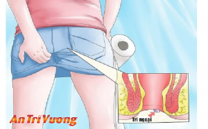 Trĩ ngoại và cách điều trị bệnh trĩ ngoại 