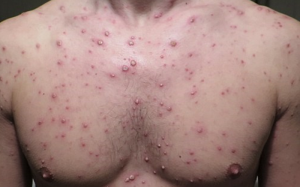 Hà Nội: Lây thủy đậu từ con trẻ, nhiều người lớn nhập viện