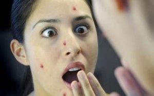Người lớn đừng để phải hối hận vì bệnh thủy đậu