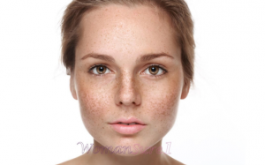 Tàn nhang không còn là nỗi lo với cách trị tàn nhang đơn giản nhất