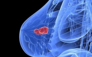 Anh: Giá thuốc trị ung thư vú Ibrance là quá đắt đối với hệ thống y tế công