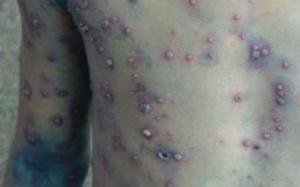 Kon Tum: Phát hiện 17 ca bệnh thủy đậu