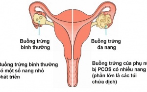 6 điều bạn chưa biết về hội chứng buồng trứng đa nang