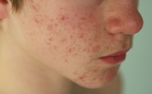 Bí quyết đánh bay mụn trứng cá ở tuổi dậy thì