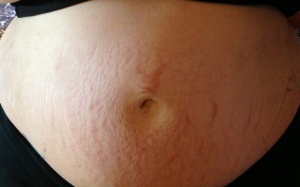 Rạn da sau sinh đã lâu có nên dùng Babolica?