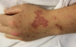 Bệnh nhi 2 tuổi tử vong nghi mắc não mô cầu