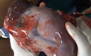 Nghệ An: Kinh ngạc bé gái chào đời còn nguyên túi ối