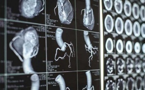 Nghiên cứu trái tim người để cải thiện điều trị rung nhĩ